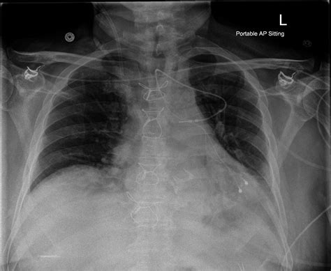 transthoracic introduction epicardial lead